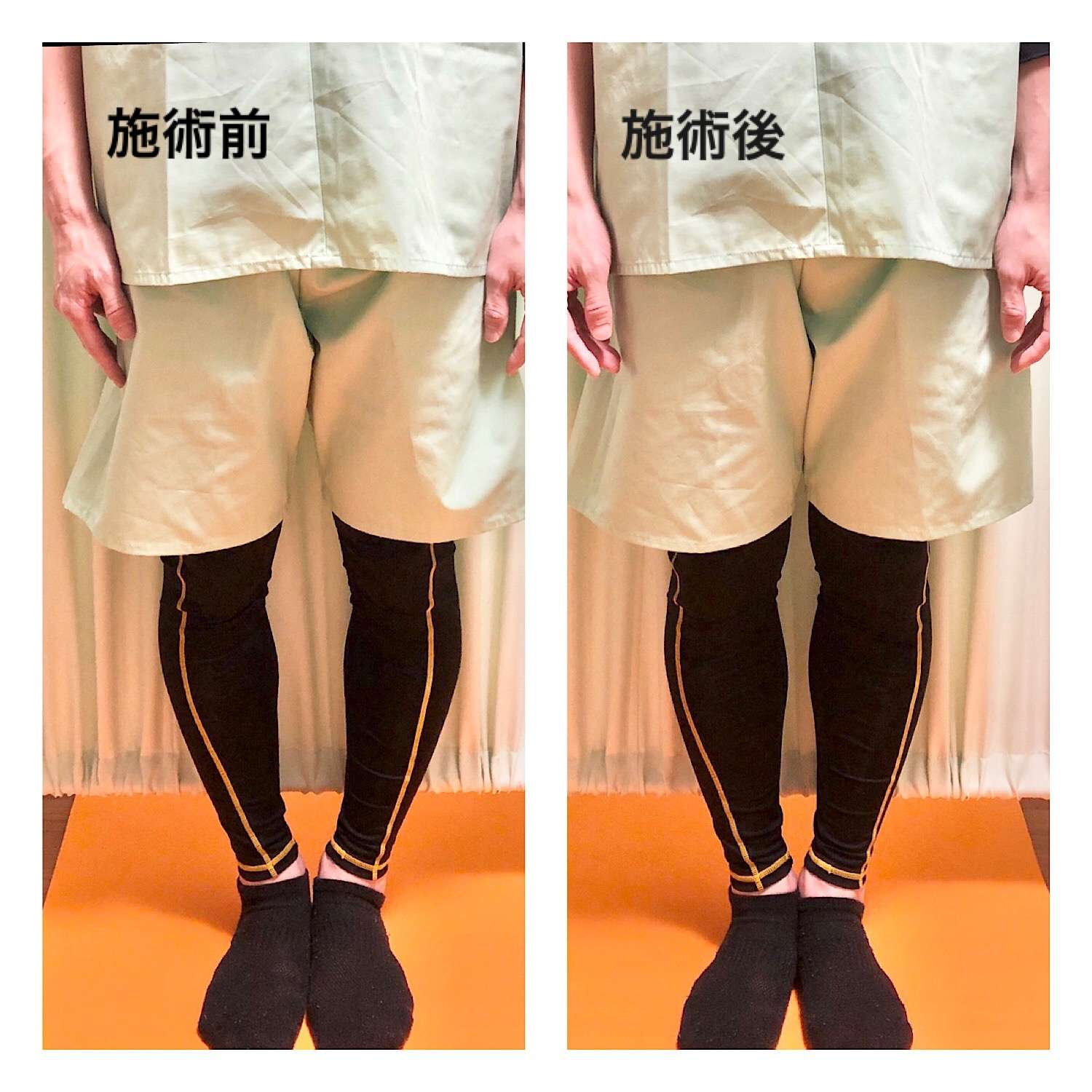 大阪市生野区内でO脚でお悩みの方、北巽の整骨院でO脚矯正をうけて綺麗な脚のラインを目指しませんか
